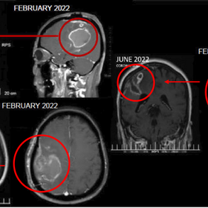 2.5cm Shrinkage in 3 Months With Combined Cancer Treatment for GBM 在3个月内采用综合癌症治疗后，脑胶质母细胞瘤缩小了2.5厘米。