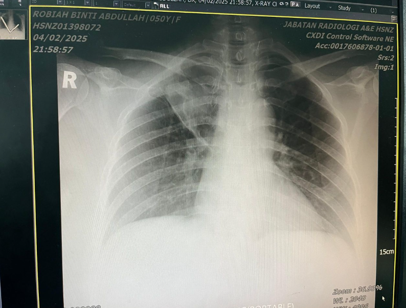 Lung with Brain Metastasis cancer