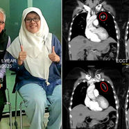 Stage 4 EGFR-Positive Lung Cancer Treatment