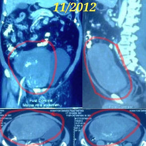 Rare Leiomyoma: Bladder Cancer Treatment Options and Support for Complete Removal 罕见平滑肌瘤：膀胱癌治疗方案与完整切除的支持