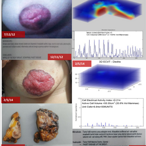 Rare Paget's Disease Treatment on her Right Breast. 帕吉特病右乳房治疗。