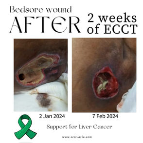 A Beacon of Hope: ECCT Impact on Liver Cancer Patient's Healing Journey in Penang 曙光之路：ECCT療法對檳城肝癌患者康復旅程的影響
