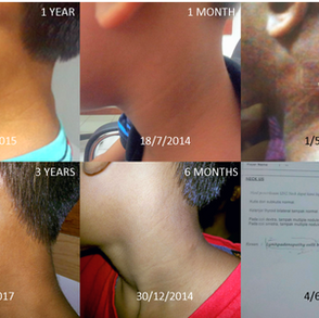Cancer-Free Without Chemo