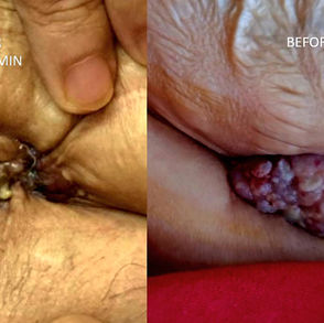 Treat Recurrent Rectal Cancer