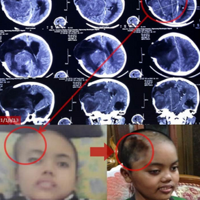 Only option treatment for GBM Glioblastoma Multiforme treatment in the right cerebrum post-op 3X within 1.5 years胶质母细胞瘤右侧大脑半球进行了1.5年内三次手术后唯一的治疗选择