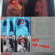 Treatment for Lung cancer metastasis to the upper segment of the anterior superior and invading the anterior mediastinal area. 肺癌转移到前上段和侵犯前纵隔区的治疗。
