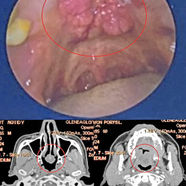 Oral Cancer Treatment Dissolved 6cm mass over 5 Months 口腔癌治疗：5个月溶解6厘米肿块