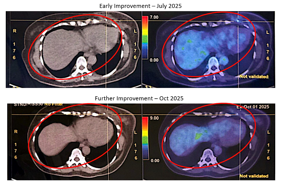 Triple Negative Breast Cancer (TNBC)