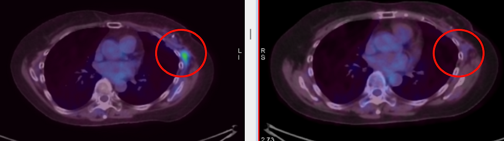 recurrence Triple-Negative Breast Cancer