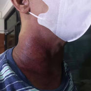 Overcoming Lung Cancer with Poorly Differentiated Adenocarcinoma 战胜低分化腺癌肺癌