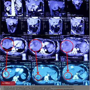 Beyond Expectations: A Triumph Result from Treatment for Stage 4 Lung Cancer with Liver Metastasis 超越预期：治疗第四期肺癌伴肝转移的胜利结果