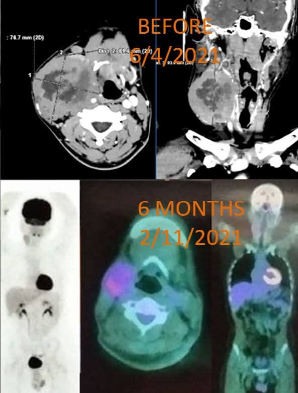 Neuroendocrine cancer diffuse non-Hodgkin’s lymphoma
