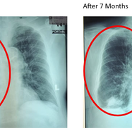 Lung tumour shrunk