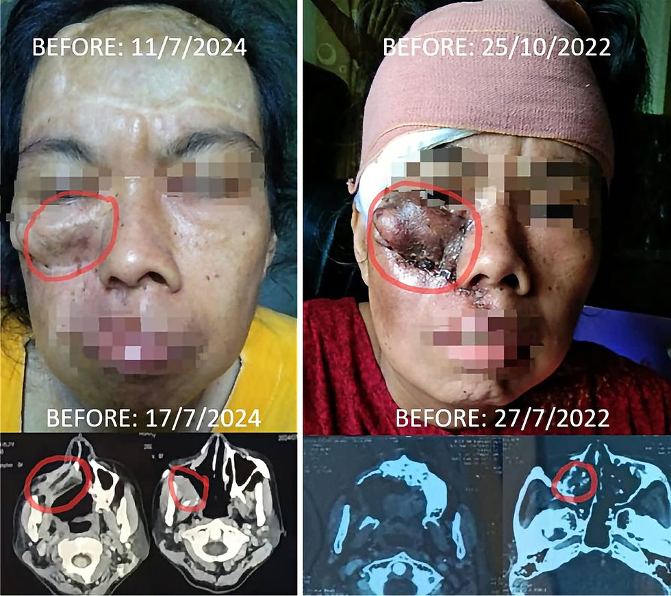 Rare Adenoid Cystic Carcinoma Cancer