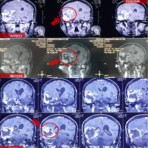 Female, 53, explore treatment for Oligodendroglioma successfully ceased the aggressive growth 53岁女性成功探索治疗寡突胶质母细胞瘤，成功阻止其侵袭性生长。