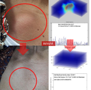 Two-Year treatment of Thyroid to Disappearance神秘消失：两年治疗甲状腺结节消失之旅