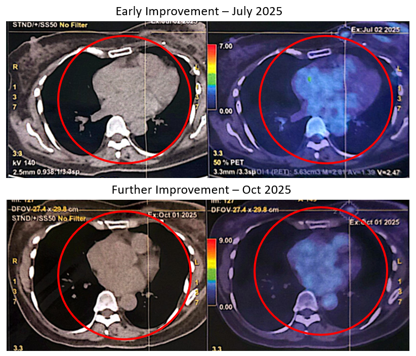 Triple Negative Breast Cancer (TNBC)