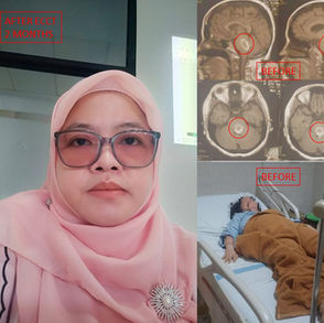 Alternative Treatment for Brainstem Hemorrhage