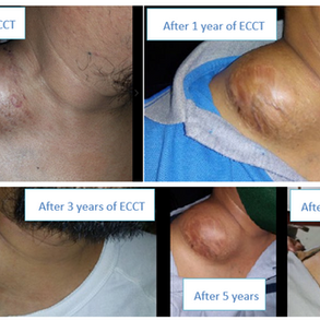 His Quality of Life Greatly Improved Post-ECCT as an Alternative Treatment for Lymphoma Cancer
