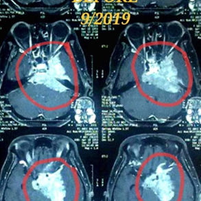 She Exploring the Best Treatment Options for Meningioma 她探索脑膜瘤的最佳治疗方案