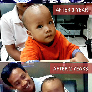 Choroid Plexus Papilloma Brain Cancer (11 Years Survivors): He Won The WAR, Not Just The Fight.