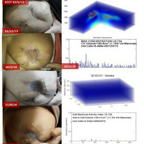 Treatment for Malignant Breast Tumor with Axillary Lymph Node Enlargement 乳腺恶性肿瘤伴腋窝淋巴结肿大的治疗