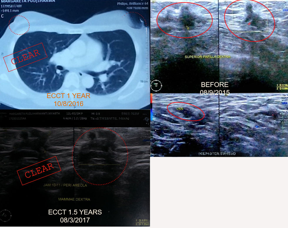 breast tumour resolved with ECCT treatment