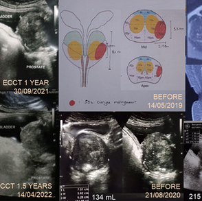 prostate cancer survived with ECCT treatment