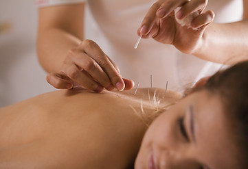 A picture of a professional inserting acupuncture needles to a woman’s body