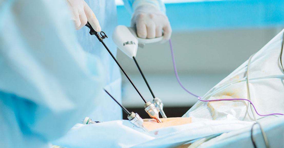 laparoscopy