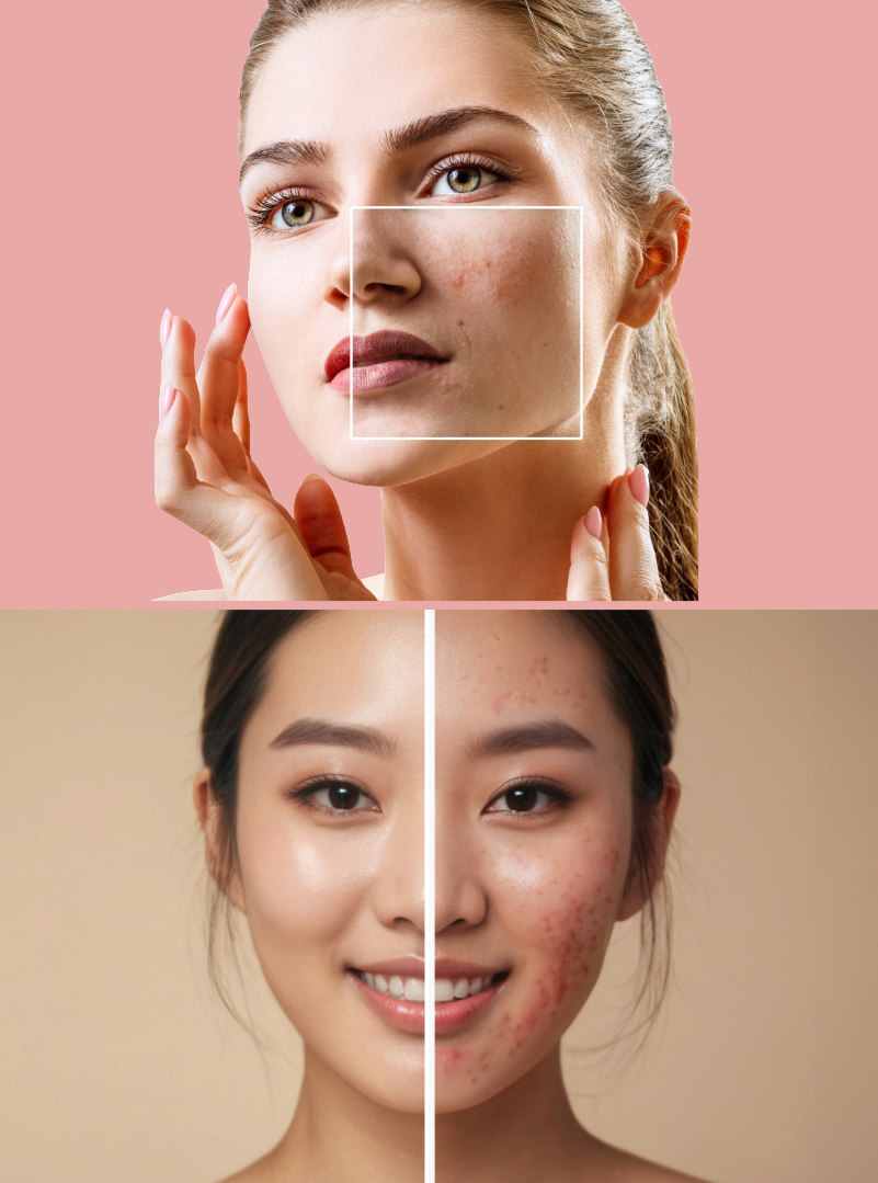 Acne before and after pictures 1.png
