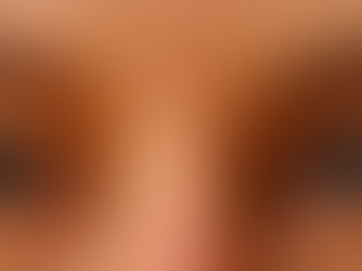 Síndrome da Pálpebra Frouxa