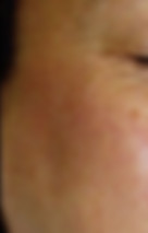 Broken Capillaries Dermalase IPL skin rejuvenation