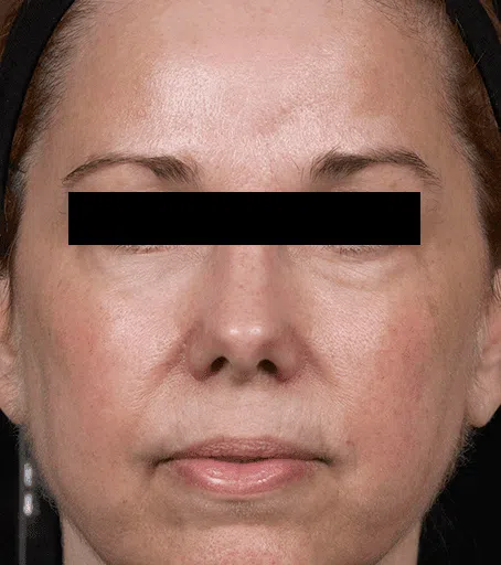 0865-CB-Permea_2_HiRes_1-Month-Post-6-Treatments.png.webp