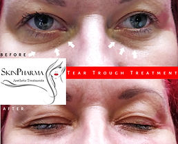 Tear trough treatment