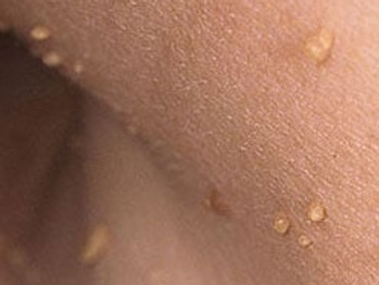 Skin tags.JPG