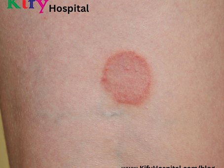 తామర పోవాలంటే ఏం చేయాలి