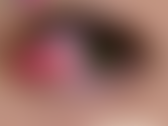 Conjunctivitis