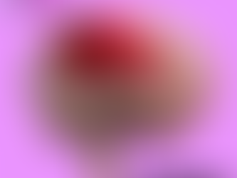 సబ్డ్యూరల్ హెమటోమా - మెదడు రక్తస్రావం