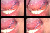 left-tongue-leukoplakia-post-op_s.jpg