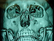 nasal-bone-and-3d-imaging.jpg