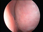 turbinate-hypertrophy.jpg
