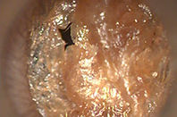 wax-impaction.jpg