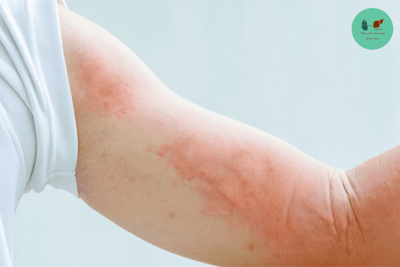 Bạn ngứa lan đỏ khắp vùng quang chỗ ngứa có các nốt sần