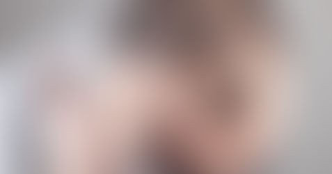 ¡No ignores las señales! Descubre cómo detectar la pérdida de cabello en sus etapas iniciales.
