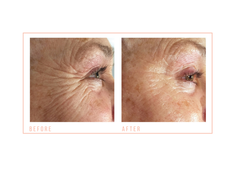 CACI, the non surgical facelift treatment loved by many!
