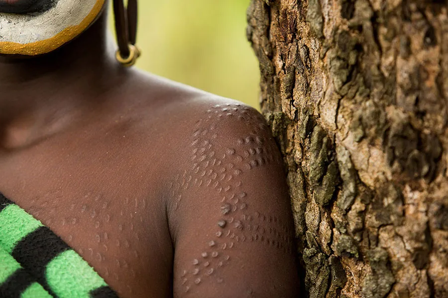 Suri beauty scars 