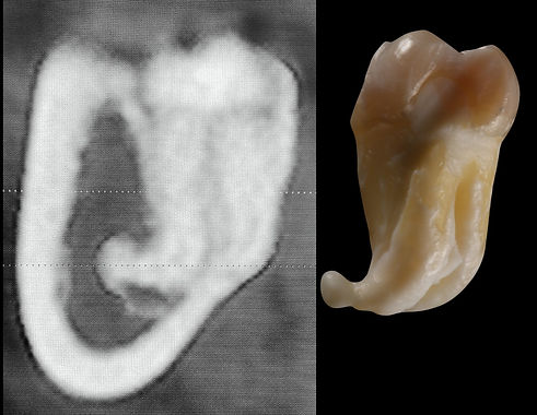dente del giudizio molto difficile (OTTAVO) estratto dopo intervento di chirurgia orale studio dentistico porta romana milano