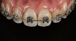 sorriso con apparecchio ortodontico tradizionale a brackets per allineamento studio dentistico porta romana milano