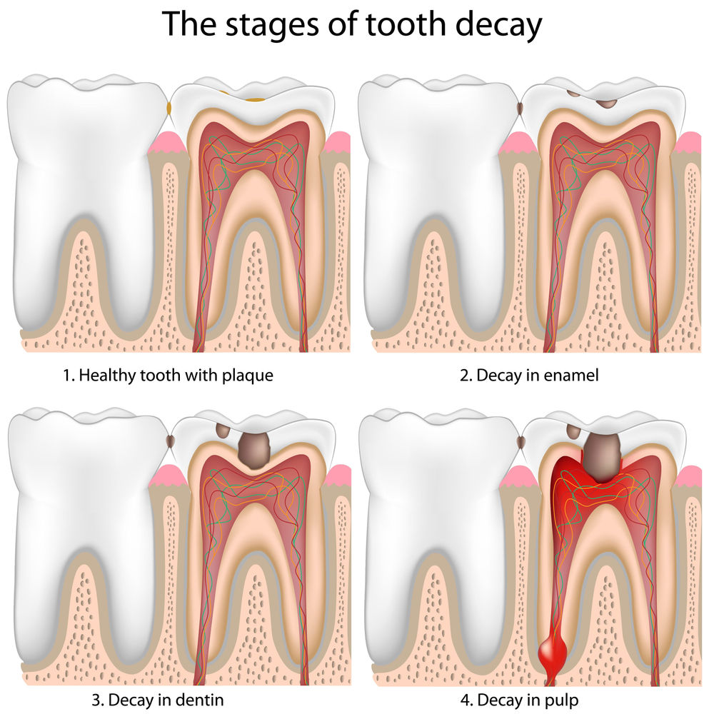 Ask a Dentist Can a tooth with a cavity be healed without a filling?